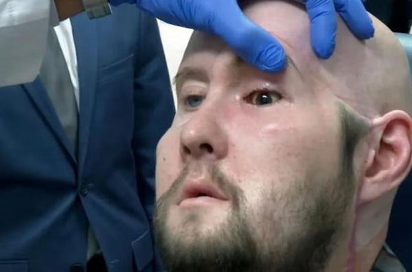 Cirujanos trasplantan con éxito el primer ojo completo del mundo