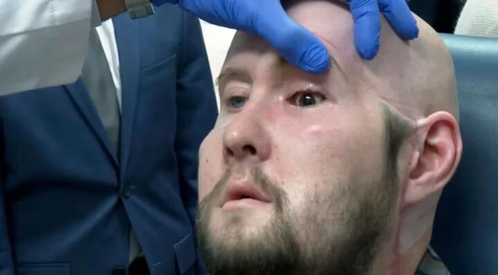 Cirujanos trasplantan con éxito el primer ojo completo del mundo