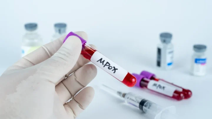 Mpox: La nueva cepa que amenaza con expandirse globalmente