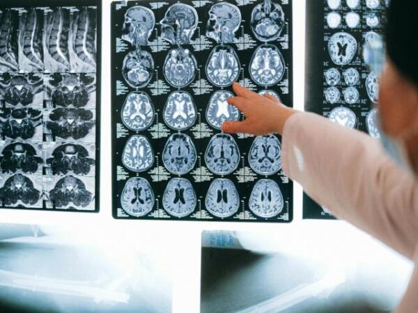 Mujeres posmenopáusicas con más cortisol, en mayor riesgo de Alzheimer