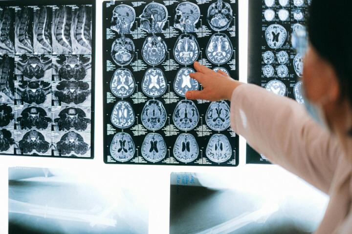 Mujeres posmenopáusicas con más cortisol, en mayor riesgo de Alzheimer Mujeres posmenopáusicas con más cortisol, en mayor riesgo de Alzheimer