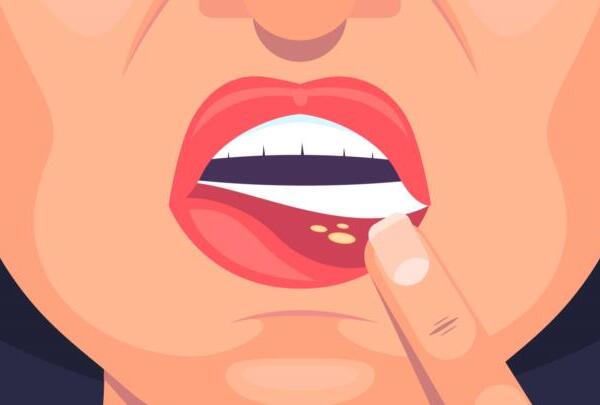 Herpes labial: ¿por qué los "fuegos" en los labios son más frecuentes durante el calor?