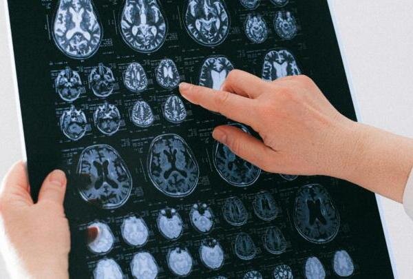 El riesgo de pasar por alto los primeros signos neurológicos