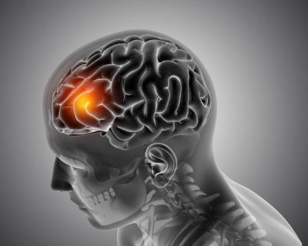 Neuralgias: ¿qué son y por qué provocan dolor intenso?