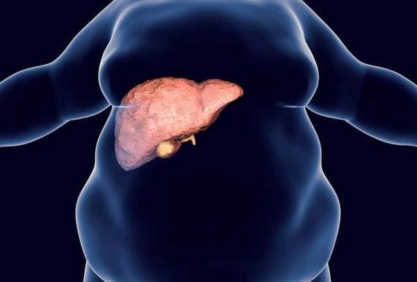 Hígado graso no alcohólico: una enfermedad en aumento