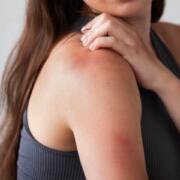 ¿Qué es la hemofilia y cuáles son sus principales síntomas?