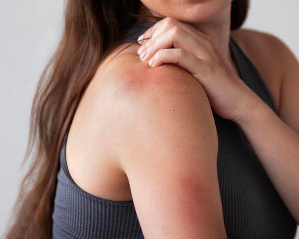 ¿Qué es la hemofilia y cuáles son sus principales síntomas?