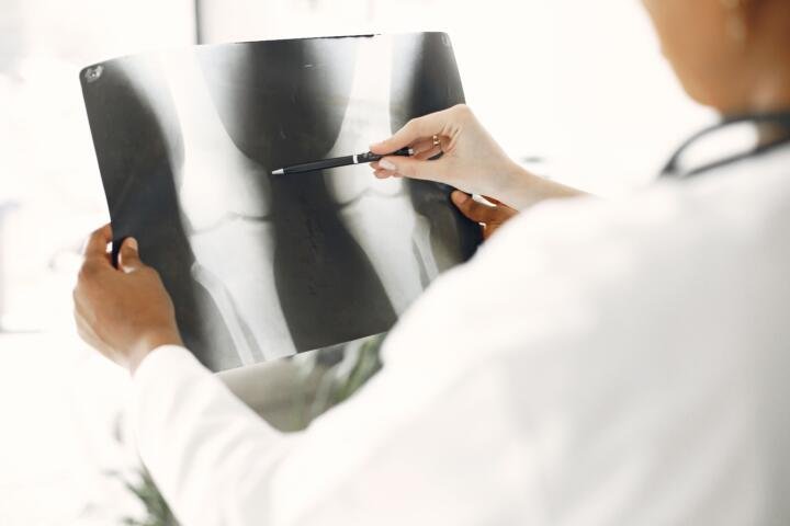 Osteoporosis: las señales que pueden aparecer antes de sufrir una fractura