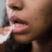 ¿Quiénes tienen mayor riesgo de desarrollar herpes zóster?