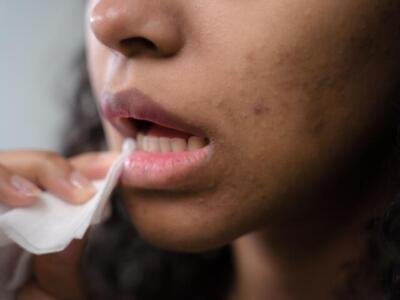 ¿Quiénes tienen mayor riesgo de desarrollar herpes zóster?