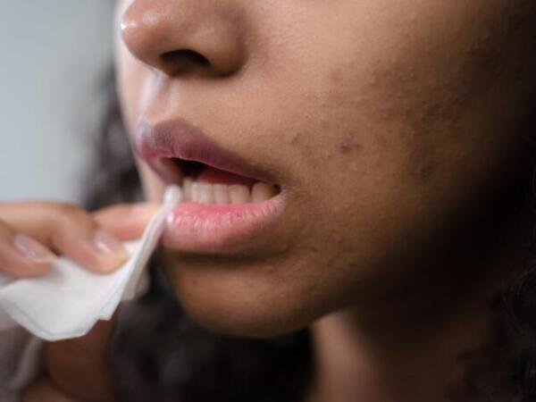 ¿Quiénes tienen mayor riesgo de desarrollar herpes zóster?