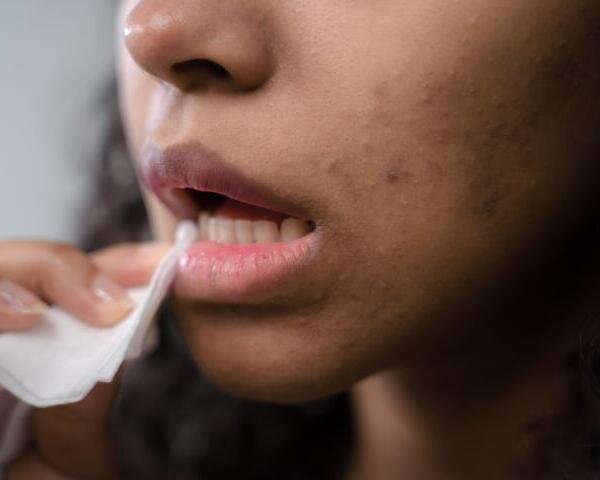 ¿Quiénes tienen mayor riesgo de desarrollar herpes zóster?