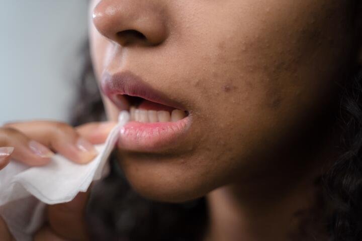 ¿Quiénes tienen mayor riesgo de desarrollar herpes zóster?